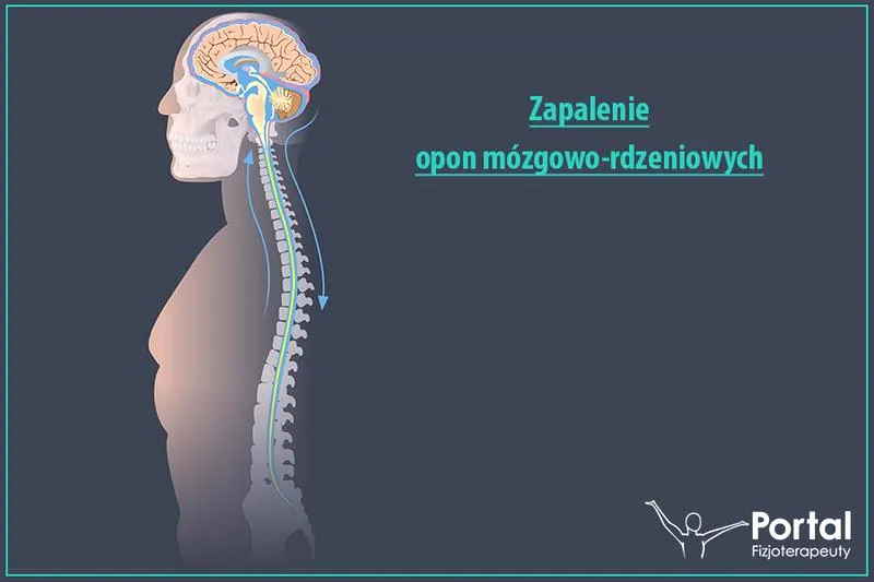 Zapalenie opon mózgowych
